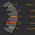 What is a Herniated Disc?