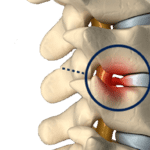 What Is a Bulging Disc?