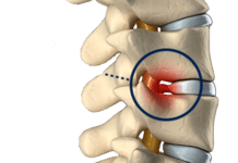 What Is a Bulging Disc?
