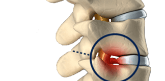 What Is a Bulging Disc?