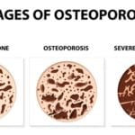 Common Osteoporosis Treatment for Bone Health