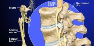 Sciatica Pain