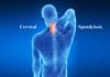 What is Spondylosis?
