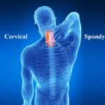 What is Spondylosis?