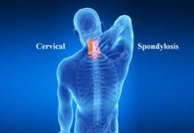 What is Spondylosis?