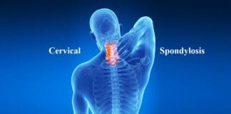 What is Spondylosis?