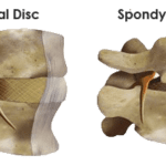 What is Spondylolisthesis?