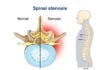 What is a Spinal Stenosis?