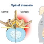 What is a Spinal Stenosis?