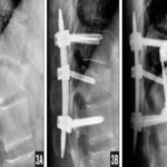 Surgery Treatment for Back Pain