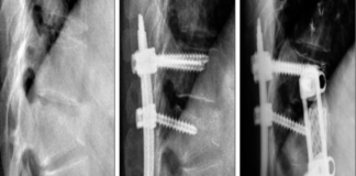 Surgery Treatment for Back Pain