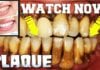 How to Remove Plaque or Tartar from your Teeth!
