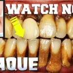 How to Remove Plaque or Tartar from your Teeth!
