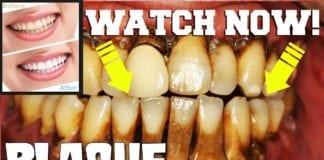 How to Remove Plaque or Tartar from your Teeth!