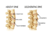 What Is Degenerative Disc Disease?