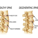 What Is Degenerative Disc Disease?