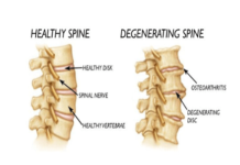 What Is Degenerative Disc Disease?
